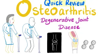 Osteoarthritis (OA) - Degenerative Joint Disease - Quick Review - Rheumatology Playlist