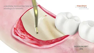 PIEZOSURGERY - ANIMATION - Horizontal tooth extraction technique Dr. Fabrizio Fontanella