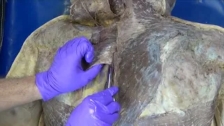 From Grant’s Dissection Video Collection: Superficial Muscles of the Back