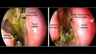 Atrophic Rhinitis or Ozena | ENT | Video lecture