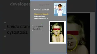 Anatomy Clavicle CCD CleidoCranial Dystosis