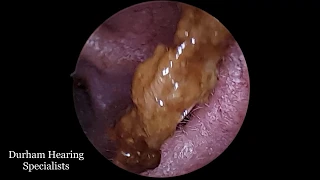 Long trail of dead skin pulled from ear canal