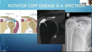 Rotator Cuff Disease for the FRCSOrth