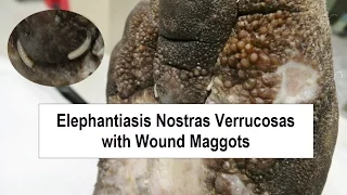 Elephantiasis Nostras Verrucosas and Wound Maggots