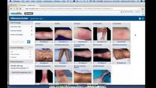 Cellulitis & Soft Tissue Infections