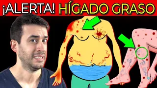 ¡Una AMENAZA SILENCIOSA! SEÑALES que INDICAN HÍGADO GRASO| PRIMEROS SÍNTOMAS