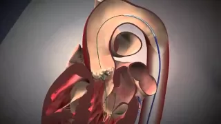 Fluoroscopy and Animation of the TAVI Procedure | NEJM