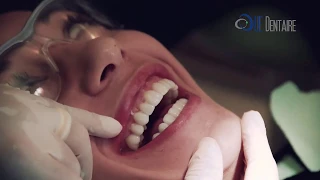 Vos facettes dentaires E.Max en 2 Rendez-vous! Carillas dentales en 2 citas! Tecnología Firstfit