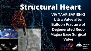 ViV TAVR SAPIEN-3 Ultra Valve after Balloon Fracture of Degenerated Redo Magna Ease Surgical Valve