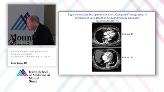 Advances and Controversies in the Management of Pulmonary Embolism