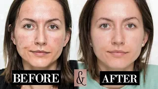 My MICRONEEDLING Experience| + Skin Updates | Before & After