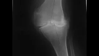 Bilateral Total Knee Replacement - Should I Replace Both Knees At The Same Time?