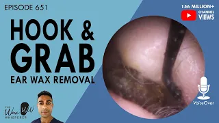 651 - Hook & Grab Ear Wax Removal