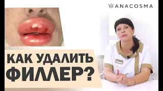 КАК УБРАТЬ ФИЛЛЕР 💉 ГИАЛУРОНОВАЯ КИСЛОТА, РАДИЕСС, ПОЛИМОЛОЧНАЯ КИСЛОТА