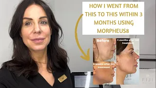 Is Morpheus8 worth it? Before & After of Morpheus8, Radiofrequency & Microneedling Review