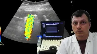 Pediatric renal ultrasound - Hyperechoic renal sinus with acoustic shadow