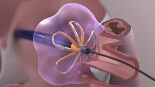 Medical Device Animation: Atrial Fibrillation Ablation Surgery