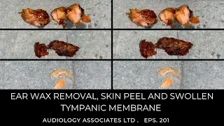 EAR WAX REMOVAL, SKIN PEEL & SWOLLEN TYMPANIC MEMBRANE - EP 201