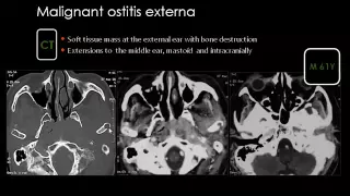 Imaging of Petrous bone part 2  Pathology    Dr Mamdouh Mahfouz