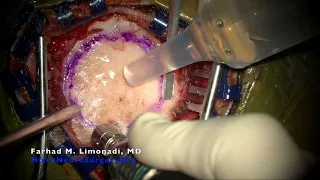 Surgical removal of a malignant brain tumor (glioblastoma multiforme or GBM) in a young patient.