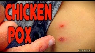 CHICKENPOX: Live Diagnosis | Dr. Paul