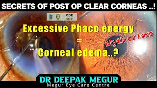 Excessive Phaco Energy During surgery. Does it cause Post Op Corneal edema..? Dr Deepak Megur