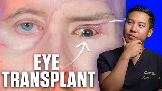 This man received the world's FIRST eye transplant, but CAN HE SEE?