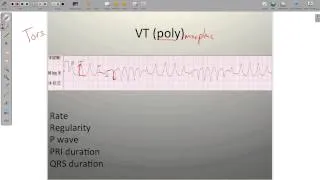 ECG Ventricular Rhythms