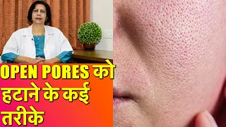 ओपन पोर्स को हटाने के कई तरीके || How To Get Rid of Large Open Pores (Permanent Treatments)