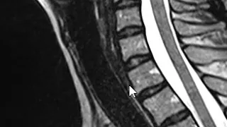 Neck MRI Scan - Parathyroid Adenoma