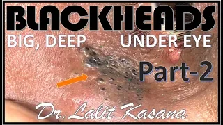 UNDER EYE DEEP BLACKHEADS PART -2 BY DR. LALIT KASANA