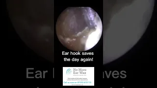 Ear hook saves the day again! #earwaxremoval #satisfying #ear #earwaxextraction #fyp #ear #earwax