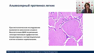 Интерстициальные заболевания легких у детей