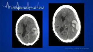 2012 Geriatric Cerebrovascular Emergencies