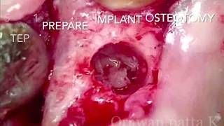 Step approach for implant coating with PRF