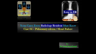 X Rays Every RR Must Know -Case 04 -Pulmonary Edema