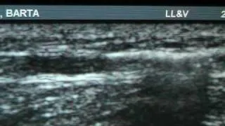 Demonstration of the Ultrasound Guided Sclerotherapy Treatment by Dr. Wright