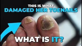 HIS TOENAILS WERE DAMAGED BY THIS THING?!