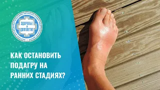 ➡ Как остановить подагру на ранних стадиях?