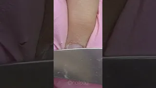 It was TOUGH 🥵 Extremely Bitten Nails Transformation