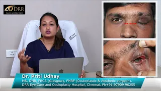 Broken Eye Socket Treatment & Eyelid Correction: Picture, Treatment, Patient Recovery