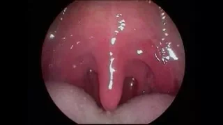 Dysphagia after Stroke: Endoscopy of the Oropharynx