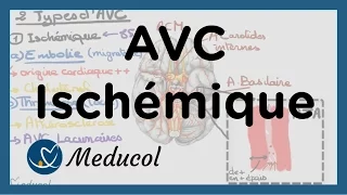 AVC ischémique: causes, embolie cérébrale, AVC thrombose et AVC jonctionnel