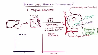 Benign liver tumors   causes, symptoms, diagnosis, treatment & pathology