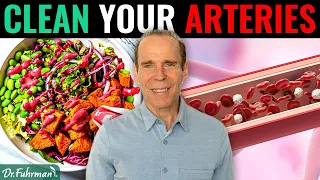 Can a Nutritarian Diet Remove Calcified Plaque in Arteries? | Dr. Joel Fuhrman