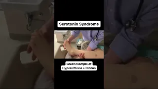 Hyperreflexia + Clonus in Serotonin Syndrome