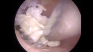 White Ear Wax Removed Revealing Infected Eardrum - Mr Neel Raithatha (The Hear Clinic)