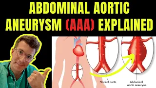 Doctor explains ABDOMINAL AORTIC ANEURYSM (AAA) | Symptoms, risk factors, treatment, screening.