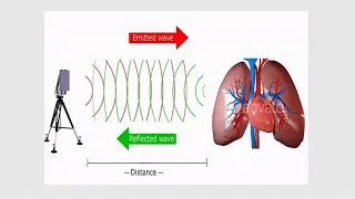 Robust mm-Wave Radar Based Heart and Breathing Rate Monitoring