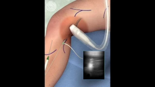 Ablation Procedure